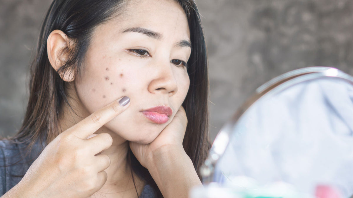  unhappy woman checking her face skin problem with dark spot from scar acne