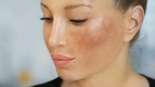 Dark spots and hyperpigmentation on woman's face