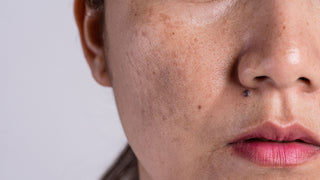  Dark spots freckles dry skin and pigmentation on woman's face