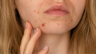 Woman showing her acne on face