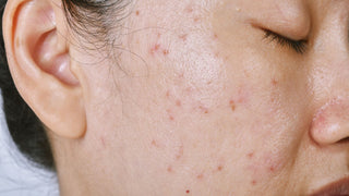 Woman with oily skin breaking out with acne