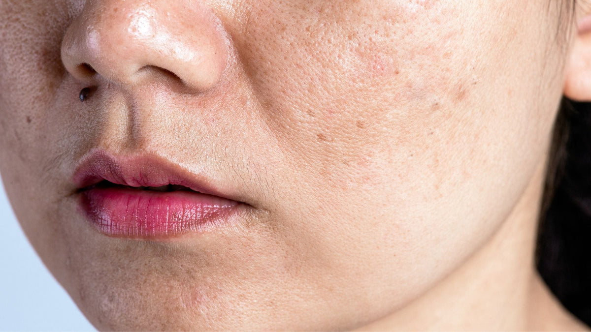 Woman with problematic skin and acne scars. Problem skincare and health concept. Wrinkles melasma Dark spots freckles dry skin and pigmentation on face
